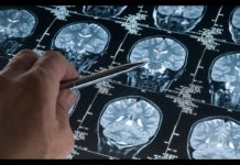 Parkinson und Alzheimer unheilbar? Nein! Neue ursächliche Behandlung